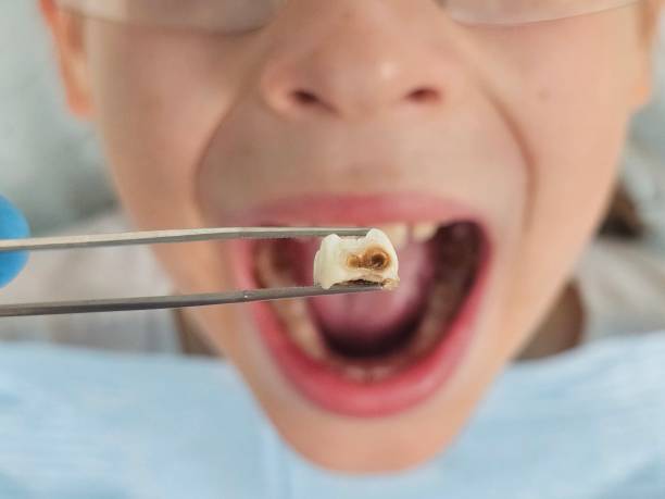 Best Emergency Wisdom Teeth Removal in Little Flock, AR